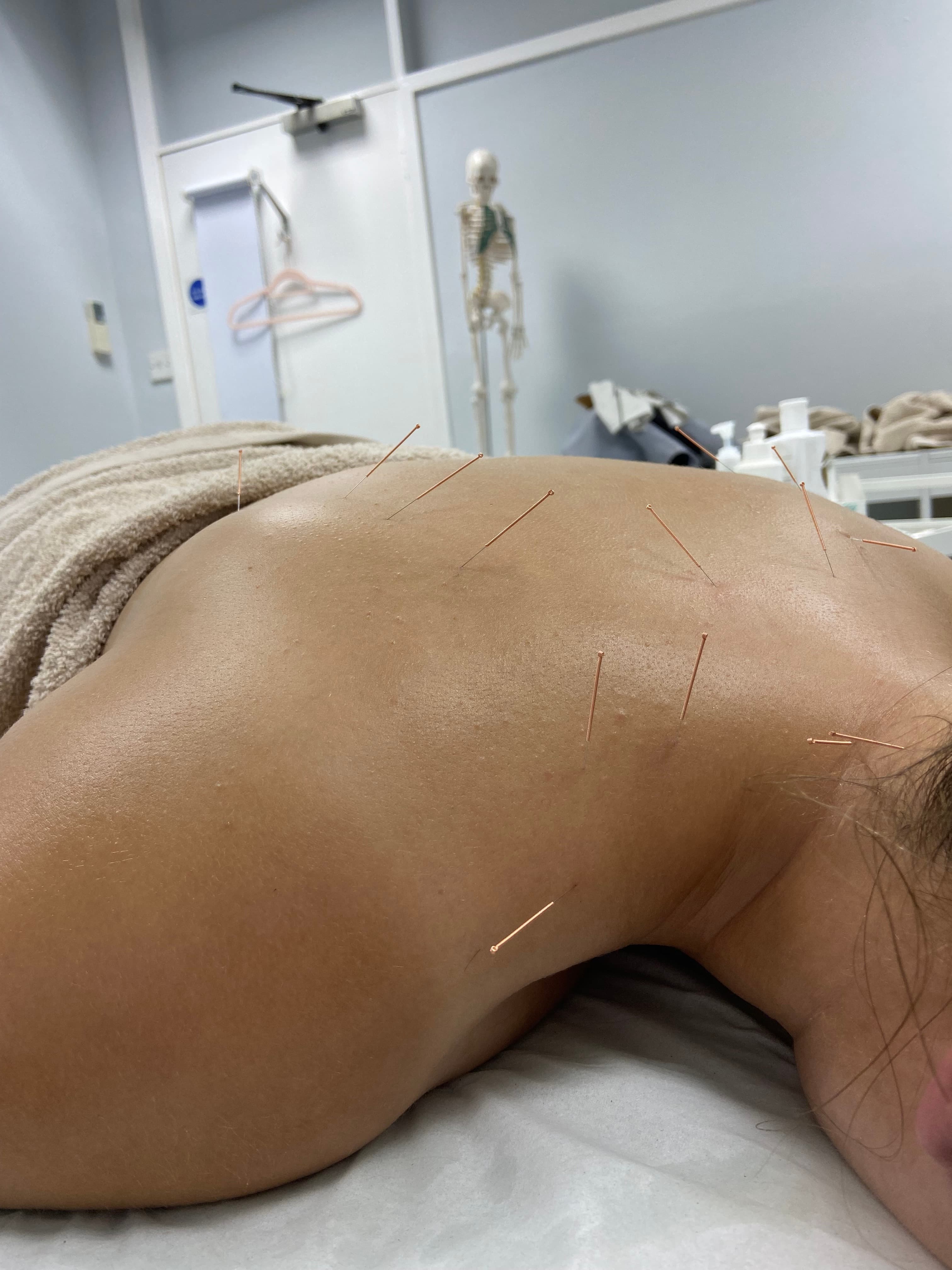 Medical Acupuncture treatment